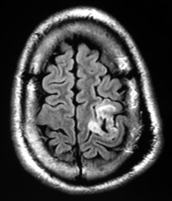 Ressonância de paciente epiléptico com tumor na área motora antes da cirurgia. no cérebro.