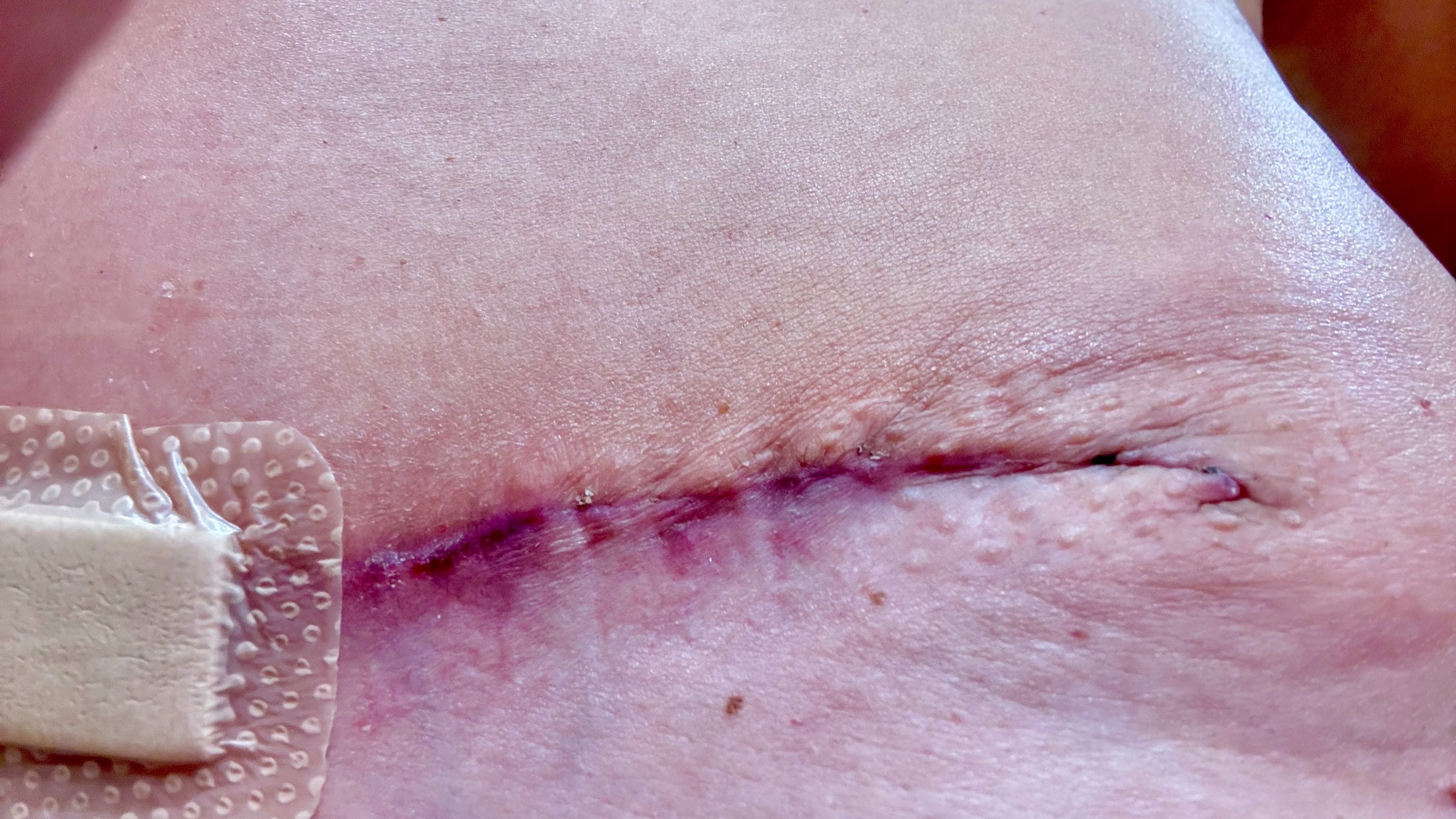 Red inflamed scar after DIEP surgery