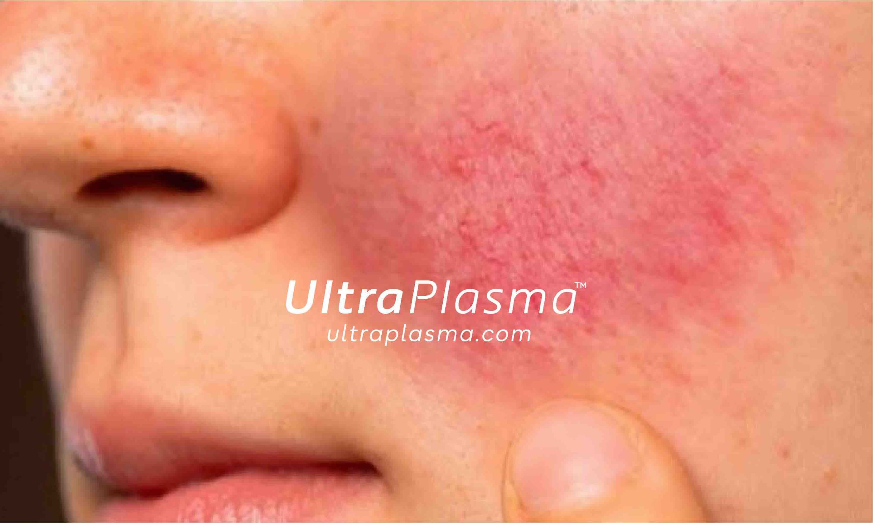 rosacea_roza_hastaligi_tedavi_treatment_ultra_plasma_ultra_plazma_ultra-plasma_ultra-plazma