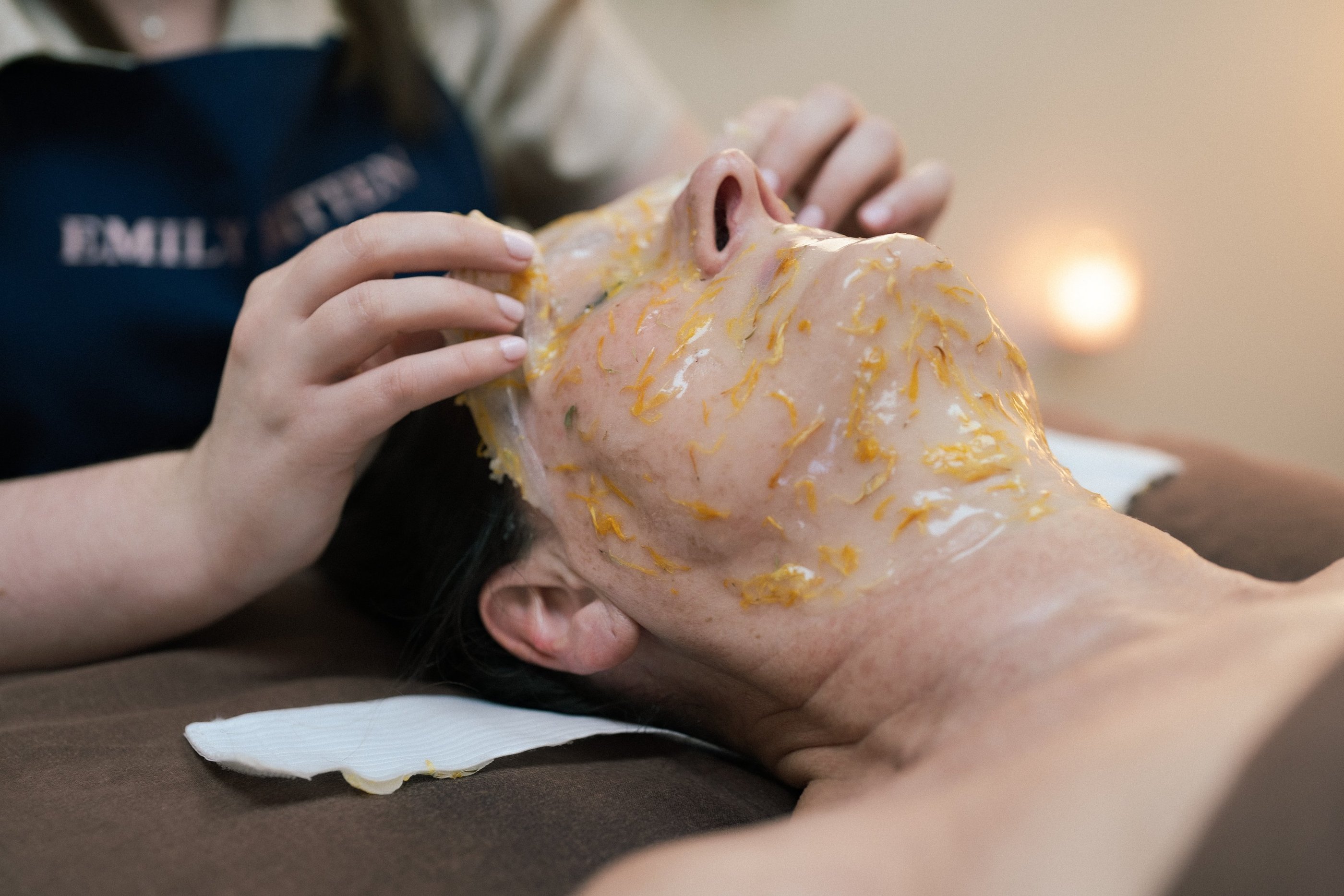 Lightening chemical peel treatment for acne scars and pigmentation in Ashford Kent.