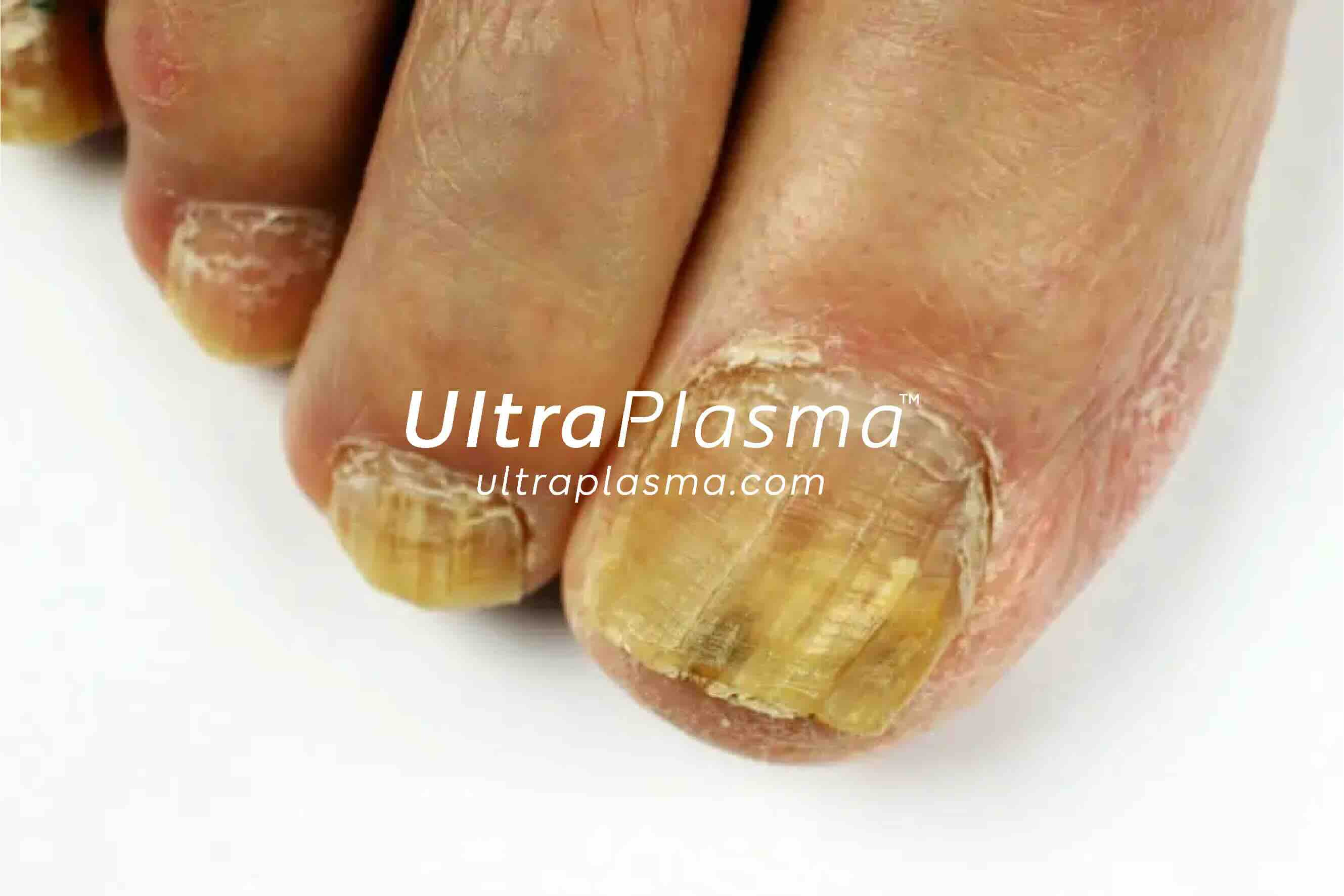 nail_fungus_onychomycosis_ultra_plasma_ultra_plazma_ultra-plasma_ultra-plazma