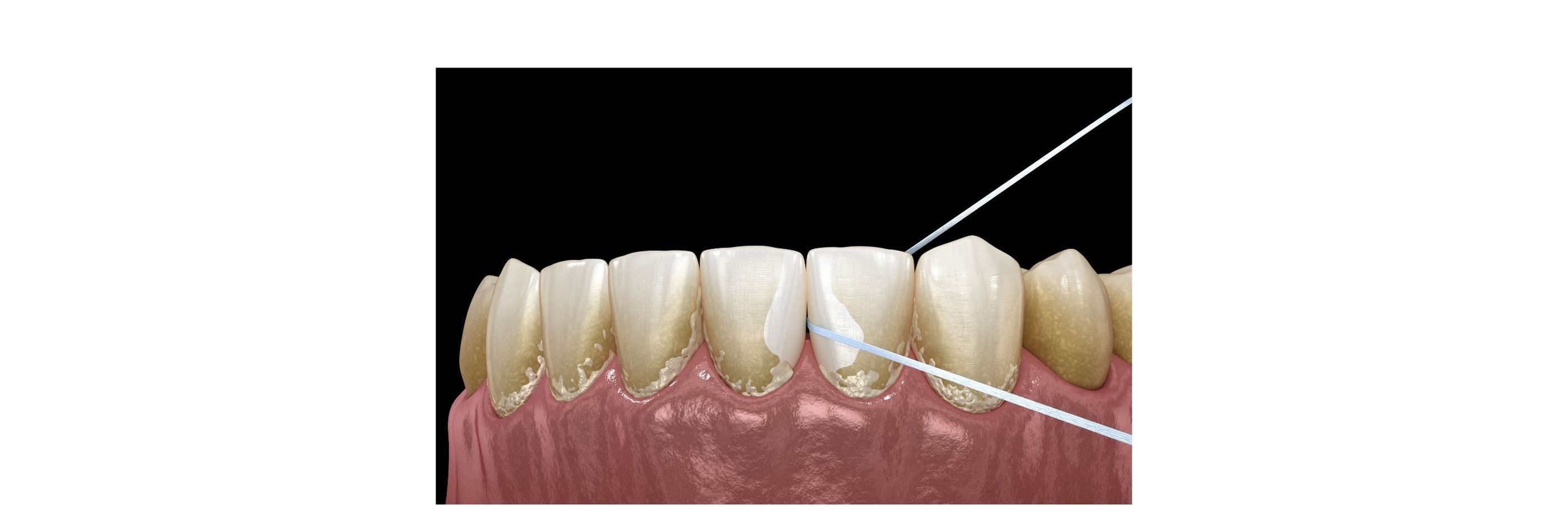 flossing with dental floss in between teeth