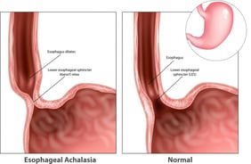 GASTRO FOUNDATION Achalasla