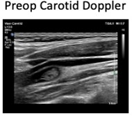 Thrombus No Flow