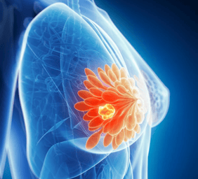 breast cancer 