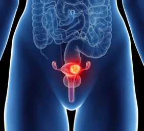 gynaecological cancer