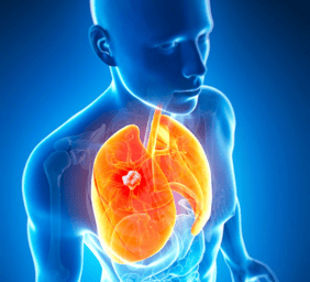 Lung Cancer