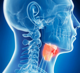 throat cancer