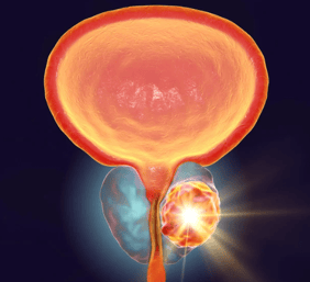 prostrate cancer