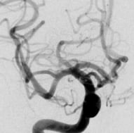 Angiografia após a cirurgia no cérebro e clipagem do aneurisma cerebral. Projeção frontal.