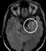 Ressonância de homem de 33 anos com crises epilépticas desde 10 meses de idade com tumor cerebral.