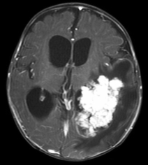 Ressonância de criança com aumento da cabeça e volumoso tumor antes da cirurgia no cérebro.
