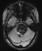 Ressonância mostrando volumoso sangramento na ponte devido ao cavernoma.