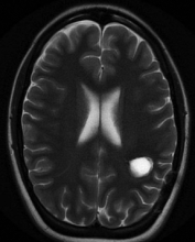 Ressonância após a cirurgia com remoção total do cavernoma.