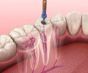 Endodontija panevezyje