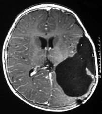 Ressonância magnética após a cirurgia com a remoção total do tumor.