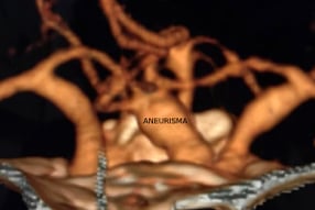 Reconstrução 3D da angiotomografia projeção frontal mostrando o volumoso aneurisma cerebral.