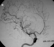 Angiografia carotídea projeção oblíqua após a cirurgia no cérebro e a retirada da MAV.