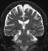 Ressonância após a cirurgia no cérebro e remoção do hematoma subdural crônico com boa recuperação.