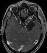Ressonância após a cirurgia no cérebro e remoção total do tumor. Sem crises após a cirurgia.