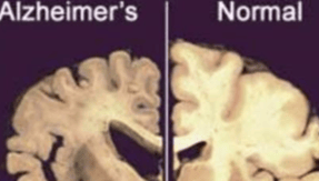 Alzheimer's