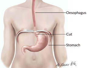 cardiomyotomy