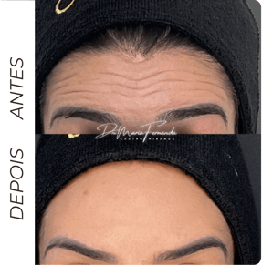 Botox em Barbacena para redução de rugas dinâmicas e prevenção de linhas de expressão