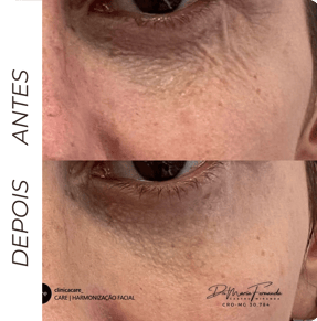 skinbooster em barbacena Reduz linhas finas, melhora a elasticidade e dá um brilho saudável.