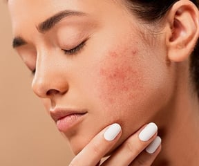 what is acne ?