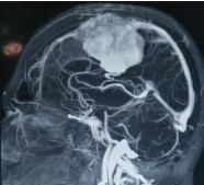 This tumour infiltrated the major dural venous sinus