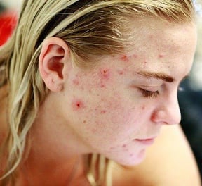 location of acne