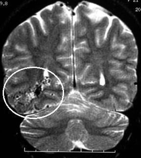 Ressonância nuclear magnética de encéfalo. O círculo mostra a MAV temporal posterior direita.