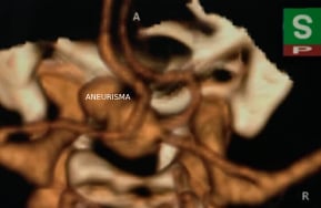 Reconstrução 3D da angiotomografia projeção perfil mostrando o volumoso aneurisma cerebral.