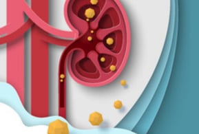 Renal Stones