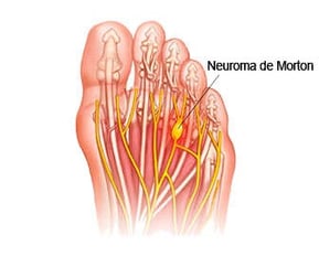 Solucion Neuroma de Morton