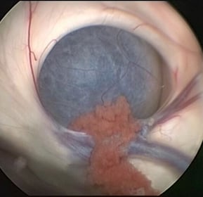 CHOROID PLEXUS