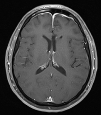 Ressonância após a cirurgia com a remoção total do tumor e paciente livre de epilepsia.