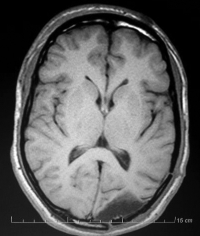 Ressonância magnética após a cirurgia com remoção total do tumor e paciente livre de epilepsia.