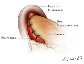 heller-dor operation