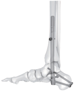 Clavo Intramedular para Artrodesis de Tobillo