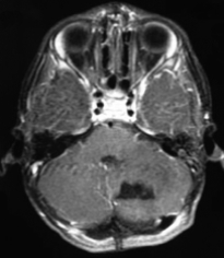 Ressonância magnética depois da cirurgia com a retirada total do tumor.