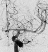 Angiografia digital projeção frontal após a cirurgia no cérebro e clipagem do aneurisma cerebral.