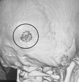 Tomografia 3D mostrando o tumor ósseo.
