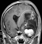Ressonância de homem de 31 anos com epiepsia refratária e volumoso tumor cerebral.