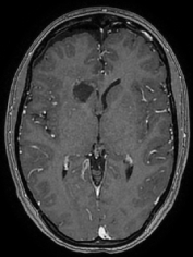 Ressonância após a cirurgia com remoção total do cavernoma e paciente livre de epilepsia.epsia.