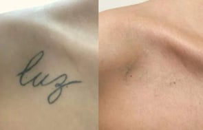 Remoção de Tatuagem
