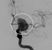 Angiografia projeção frontal da mesma paciente. O círculo indica o volumoso aneurisma cerebral.