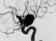 Angiografia digital projeção perfil mostrando o mesmo aneurisma cerebral.