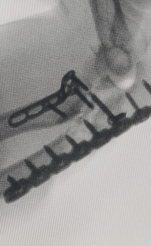 Placa de reconstrucción y placa para radio proximal