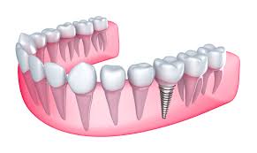 a dental implanting implanting teeth and teeth